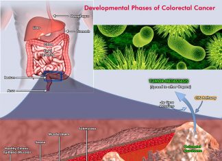 Researchers identify microbial signatures for colorectal cancer