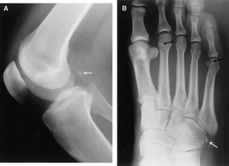 The fabella – arthritis-linked knee bone – has made a surprising resurgence over the last century