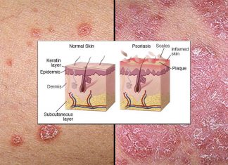 Studies have linked psoriasis and higher weight
