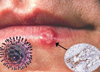 The herpes simplex virus may account for 50% of Alzheimer’s disease cases