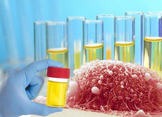 Urine test may be as effective as the smear test and prevent cervical cancer