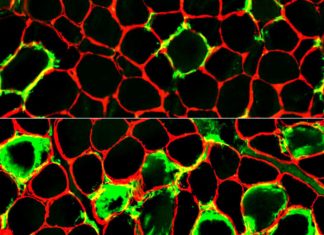 Researchers identified unknown autoimmune muscle disease involving sudden onset of debilitating muscle pain