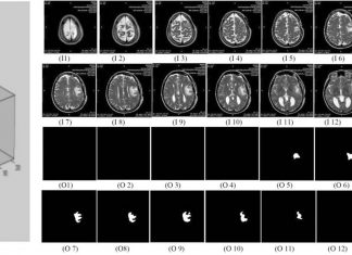 Researchers has developed a new method for the automated image analysis of brain tumors individualizing treatment