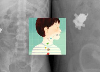 Emergency department : 759000 children younger than six years have ingested foreign body