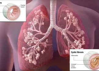 Researchers developed a way to test multiple drugs on cells obtained from individual patients with cystic fibrosis