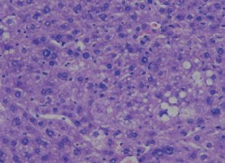 Why hepatocellular carcinoma (HCC) is more common in men ?