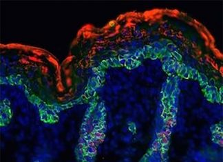 Researchers helps explain how tumors recruit blood vessels