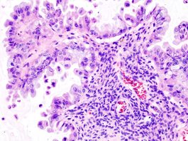 Few women with ovarian cancer are tested for the presence of mutations that could be used to guide health care decisions