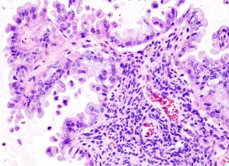 Few women with ovarian cancer are tested for the presence of mutations that could be used to guide health care decisions