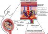 Allopregnanolone (ALLO) can leave fetus vulnerable to autism spectrum disorder (ASD)