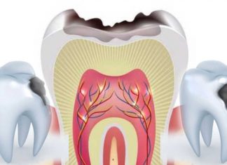 Dentistry’s Researchers : body’s own defence system could be a major contributor to tooth decay and filling failure