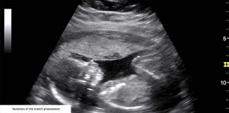 Additional routine ultrasound could eliminate undiagnosed breech presentation of babies