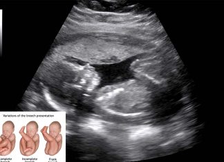 Additional routine ultrasound could eliminate undiagnosed breech presentation of babies