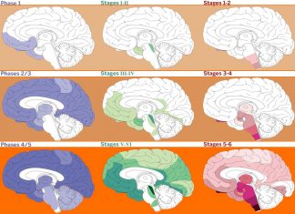 A-β and Tau Prion Activity Linked to Alzheimer’s Patients’ Longevity