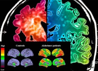 Researchers have identified the first human-specific fusion gene implicated in Alzheimer’s disease