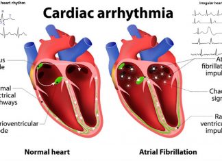 Arrhythmia in people with no genetic predisposition is an acquired condition