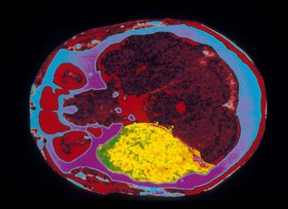 Capsular polysaccharide A (PSA) protect against fatal neuroinflammation