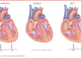 Blood-pressure and glucose control may be effective in preventing heart block