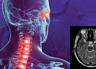 The drug eculizumab significantly reduced the risk of relapse with neuromyelitis optica spectrum disorder (NMOSD)