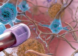 New blood test can help detect Alzheimer’s disease in presymptomatic patients