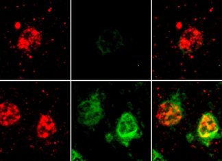 First comprehensive analysis of the genes that are expressed in individual brain cells of patients with Alzheimer’s disease
