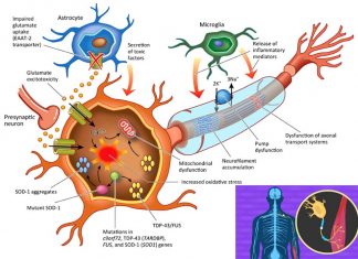 Researchers have developed a stem cell-based model to provide information about neuron resilience in ALS