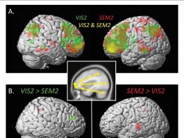 The left rostrolateral prefrontal cortex plays a critical role in memory recall