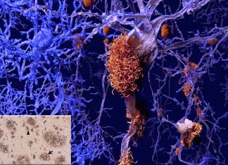 A particular class of molecules may help with diagnosing Alzheimer’s Disease
