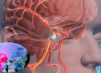 An important class of drug used to treat cancer patients could be used to treat brain aneurysms