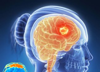 Brain cancer : FLASH radiotherapy dramatically reduces the adverse cognitive side effects