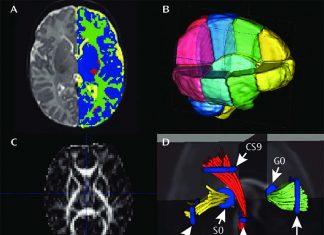 MRI 3-D images show how infants’ brains and skulls change shape during birth