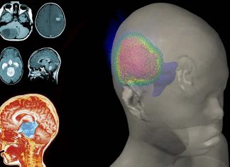 Researchers have identified the cells that give rise to certain brain tumours in children