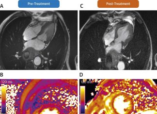 Researchers have show that MRI can be used to measure how the heart uses oxygen
