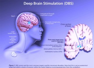 First clinical trial of DBS for methamphetamine addiction