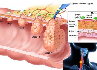 Researchers have found a way to target drug-resistant esophageal cancer cells