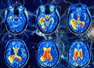 New method use functional magnetic resonance imaging (fMRI) to diagnose autism
