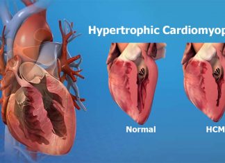 Researchers have borrowed a brain imaging technique to spot hypertrophic cardiomyopathy