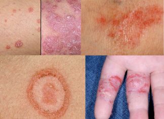 Researchers has found a connection between a skin microbiome imbalance and eczema flareups