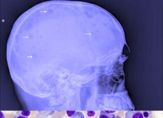 Researchers have discovered a way to prevent kidney failure from occurring in people with multiple myeloma