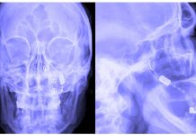 New nerve stimulation therapy can increase blood flow and help patients with stroke up to 24 hours after onset