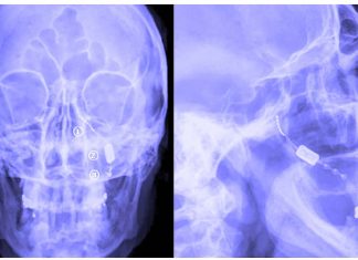 New nerve stimulation therapy can increase blood flow and help patients with stroke up to 24 hours after onset