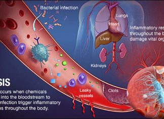 Why have several recent clinical trials of sepsis treatments failed?