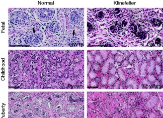 Testicular tissue biopsies contain stem cells with the potential of generating sperm from biopsied tissue