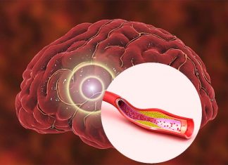 Women experiencing a minor stroke are less likely to be diagnosed with a stroke compared to men