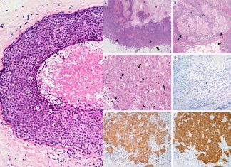 Researchers has developed a strategy that slows the growth of triple negative breast cancer cells