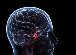 AI could soon help doctors in the diagnosis of brain aneurysms
