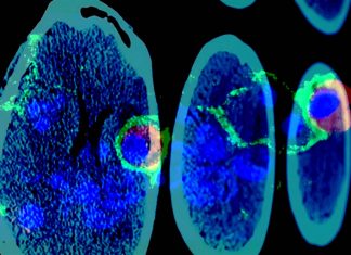 Advanced imaging techniques visualize macrophages in brain tumors