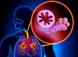 Asthma – Researchers have studied which genes are expressed in overactive immune cells in inflammation of the airways
