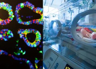 Babies born prematurely : intestine transplant can benefit some patients but also stem cell therapy is poised to become a game-changer