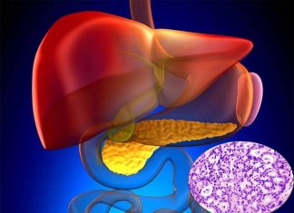 New combination of cancer drugs can improve outcomes in patients whose pancreatic cancer is too close to a blood vessel to be removed safely